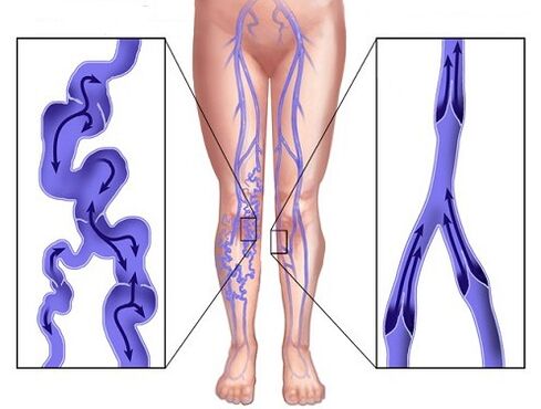 Comparaison des veines affectées par les varices et les veines après avoir utilisé Veniselle