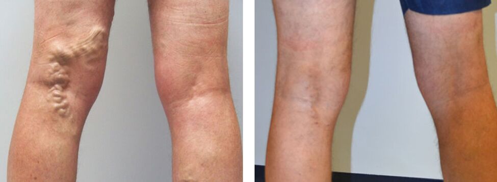 Photo avant et après l'utilisation de Veniselle, l'expérience de l'utilisation de la crème