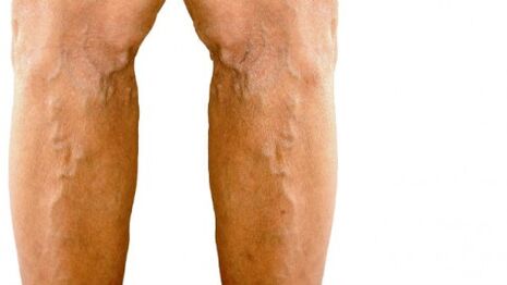 Manifestations visibles des varices dans les jambes