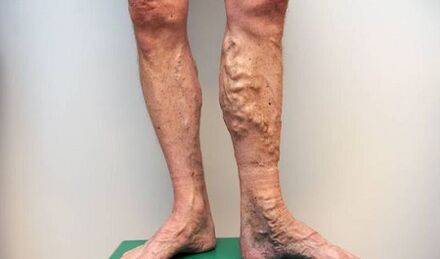 varices chez les hommes