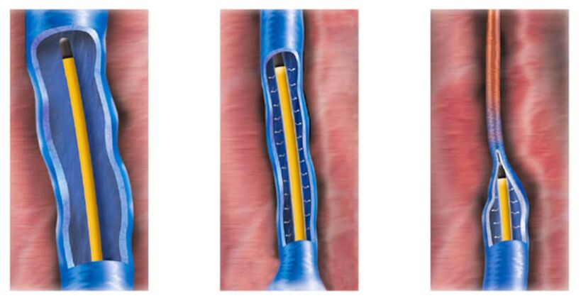 Ablation par radiofréquence comme méthode de traitement des varices.