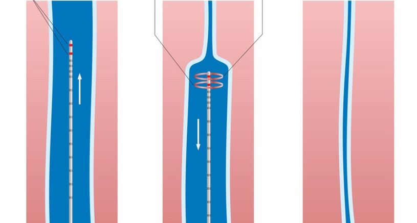 Traitement au laser des varices des jambes.