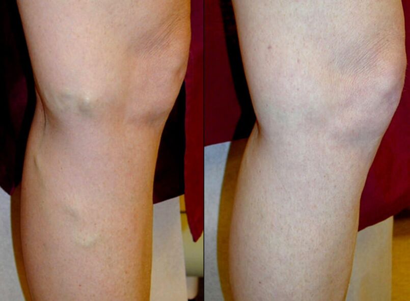 méthodes pour traiter les varices dans les jambes